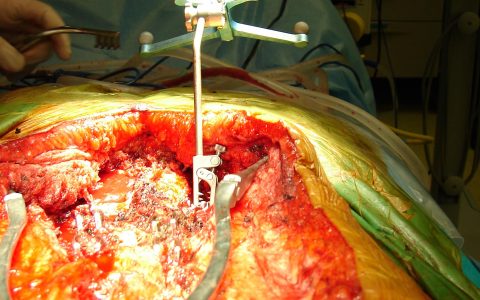 Περίπτωση Ολ.Ρα: Επανεγχείριση διορθωτικής σπονδυλοδεσίας σκολίωσης ενηλίκων