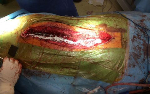 Περίπτωση Πα. Γι.: Επανεγχείρηση σκολίωσης ενηλίκων