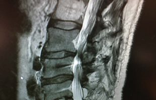 Περίπτωση Πα.Κο. Αιμαγγείωμα Σπονδυλικής Στήλης – Κυφοπλαστική
