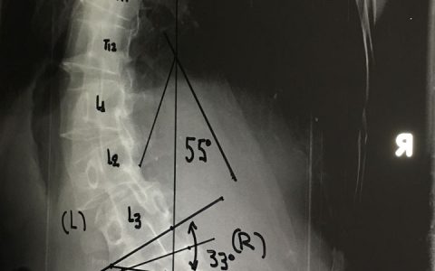 Περίπτωση : Νε. Πο. Ιδιοπαθής σκολίωση ενήλικος
