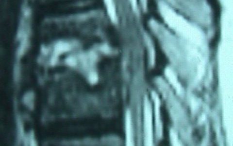 Περίπτωση Ευ. Πυ.: Σταφυλοκοκκική λοίμωξη σπονδυλικής στήλης