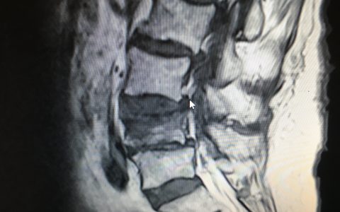 Περίπτωση Δη.Φυ.: Οστεοπορωτικά Κατάγματα Σπονδυλικής Στήλης και Αντιμετώπιση αυτών