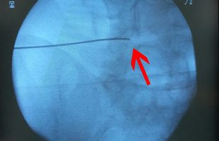 Δισκοπλαστική Μεσοσπονδυλίων Δίσκων