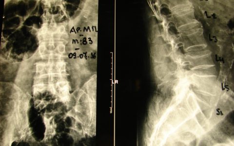 Περίπτωση Αρ. Μπ. – Πολλαπλά οστεοπορωτικά κατάγματα σπονδυλικής στήλης