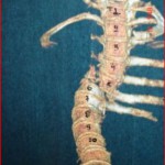 Case: Μ. Ch. – Thoracic Spinal Injury: Οperative treatment and related problems