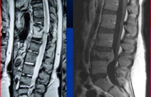 Νεοπλασίες Σπονδυλικής Στήλης