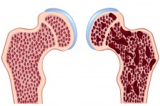 Internal Fixation