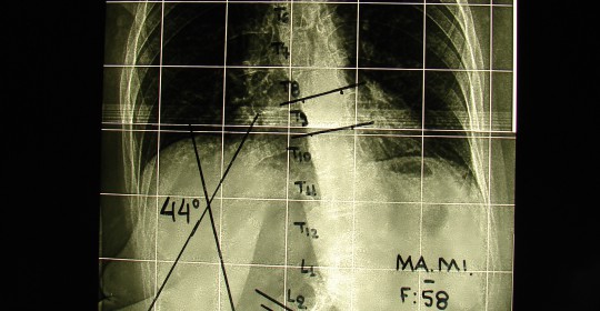 Περίπτωση Μα. Μι. – Σκολίωση Ενήλικος Χειρουργηθείσα- Παραμορφώσεις Σπονδυλικής Στήλης