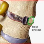 Μεσοσπονδύλιος Σπονδυλοδεσία