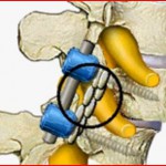 Σπονδυλοδεσία