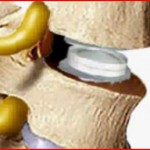 Τεχνητός Μεσοσπονδύλιος Δίσκος