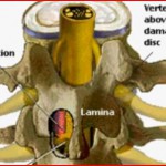Μικροχειρουργική Δισκεκτομή