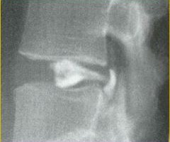 Νόσος Εκφυλισμένου Δίσκου Σπονδυλικής Στήλης