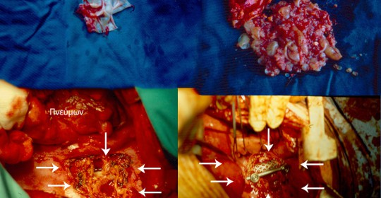 echinococcus-treatment