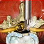 Ενδοσκοπική Δισκεκτομή