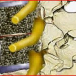 Λοίμωξη Σπονδυλικής Στήλης