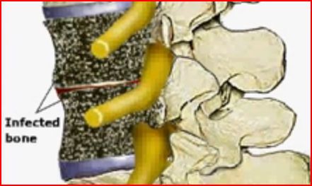 Λοίμωξη Σπονδυλικής Στήλης