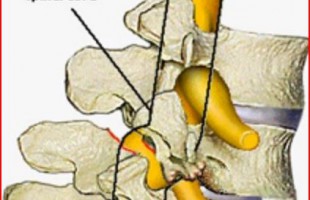 Ισθμική Σπονδυλολίσθηση