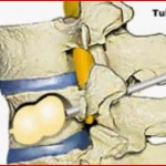 Κυφοπλαστική
