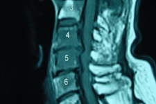 Νεοπλασματικές Παθήσεις της Σπονδυλικής Στήλης