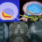 Νεώτερες Τεχνικες στη χειρουργική της Οσφυικής Μοίρας Σπονδυλικής Στήλης