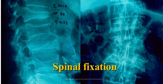 Operative treatment of osteoporotic fractures