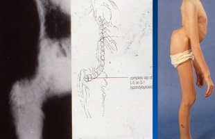 Σπονδυλόλυση – Σπονδυλολίσθηση (Spondylolisthesis)