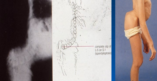 Σπονδυλόλυση – Σπονδυλολίσθηση (Spondylolisthesis)