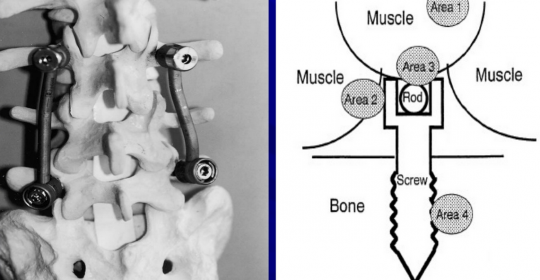 Tissue Reaction in spinal implants