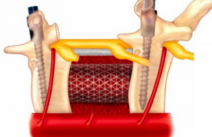 Total Vertebrectomy