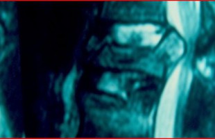 Χειρουργική αντιμετώπιση των κακοήθων νεοπλασιών της σπονδυλικής στήλης