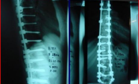 Operative treatment of Idiopathic Adolescent Scoliosis