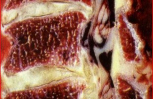 Cervical Spondylosis