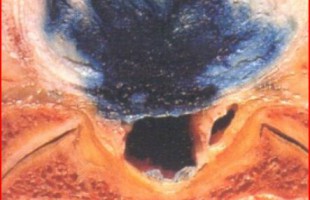 ΔΙΣΚΟΣ – ΚΟΛΛΑΓΟΝΟ