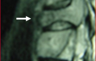 Πρωτοπαθείς και  Μεταστατικοί Όγκοι της Σπονδυλικής Στήλης και η Αντιμετώπισή τους