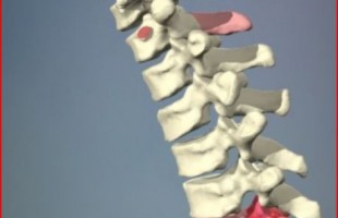 The midline and lateral parascapular extrapleural exposures