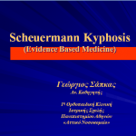 Θωρακική κύφωση