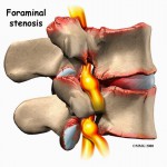 Σπονδυλική Στένωση