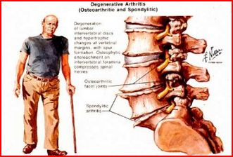 Natural History of Aging Spine 2015 (Η διαχρονική εξέλιξη της σπονδυλικής στήλης)