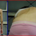 Παιδική – Εφηβική Σκολίωση – Scoliosis 2015