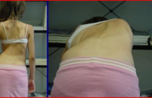 Παιδική – Εφηβική Σκολίωση – Scoliosis 2015