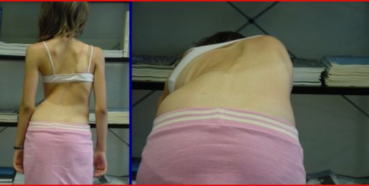 Παιδική – Εφηβική Σκολίωση – Scoliosis 2015