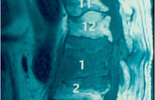 Operative treatment of osteoporotic spine