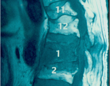 Operative treatment of osteoporotic spine