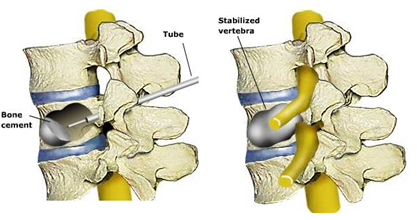 Vertebroplasty and Kyphoplasty. A review. (en)