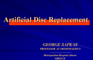 Artificial Disc Replacement