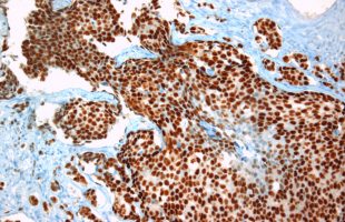 An interesting case St.