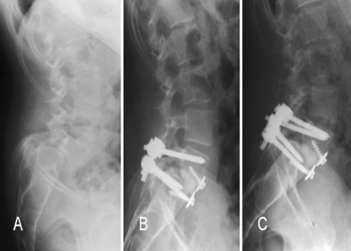 Spondyloptosis