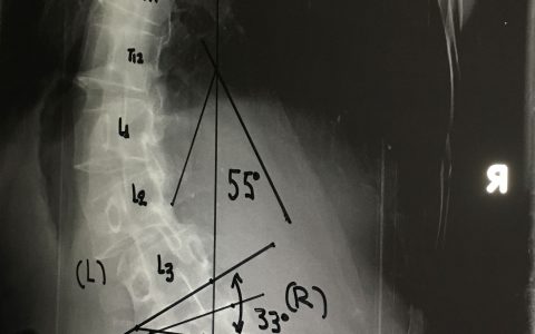 Περίπτωση Ν. Π.: Σκολίωση Ενηλίκων – Χειρουργική Αντιμετώπιση