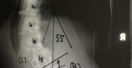 Περίπτωση Ν. Π.: Σκολίωση Ενηλίκων – Χειρουργική Αντιμετώπιση